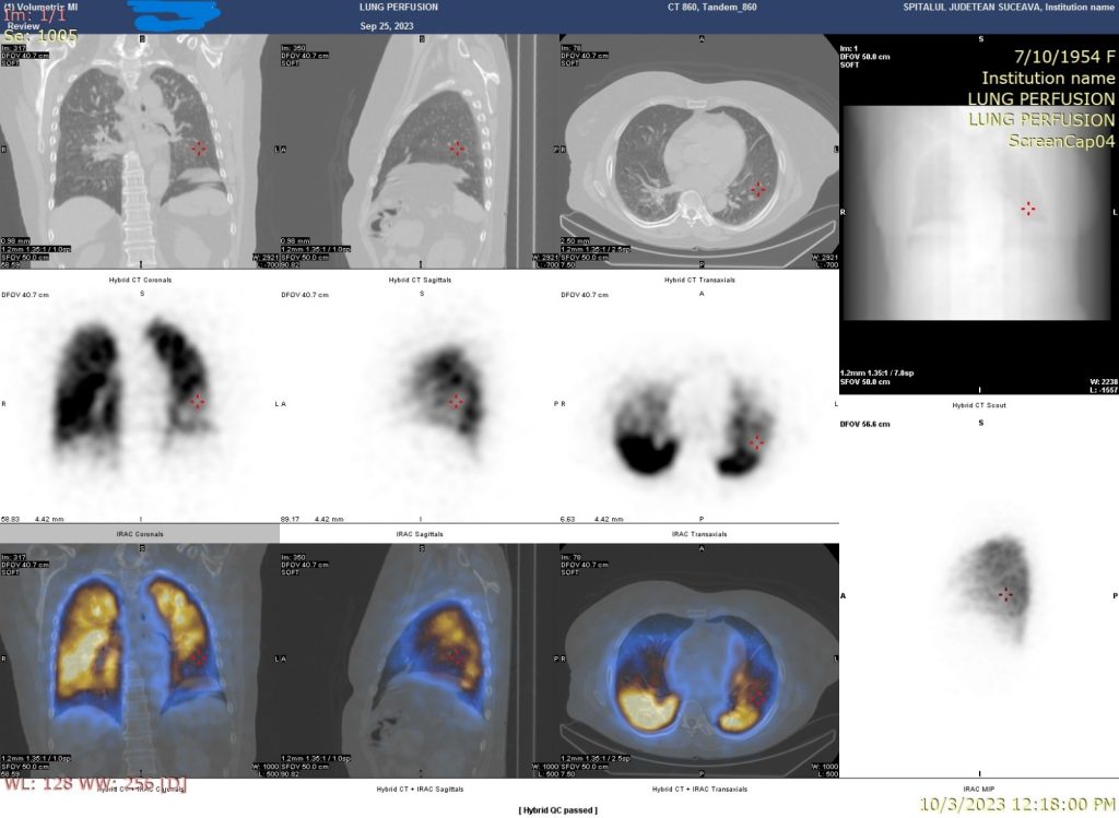 Diagnosticul scintigrafic al emboliei pulmonare în premieră pentru regiunea Moldovei 