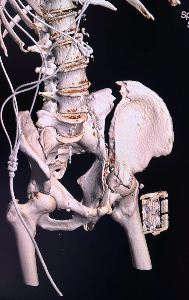 Prima intervenţie de osteosinteză cu machetă 3D preoperator