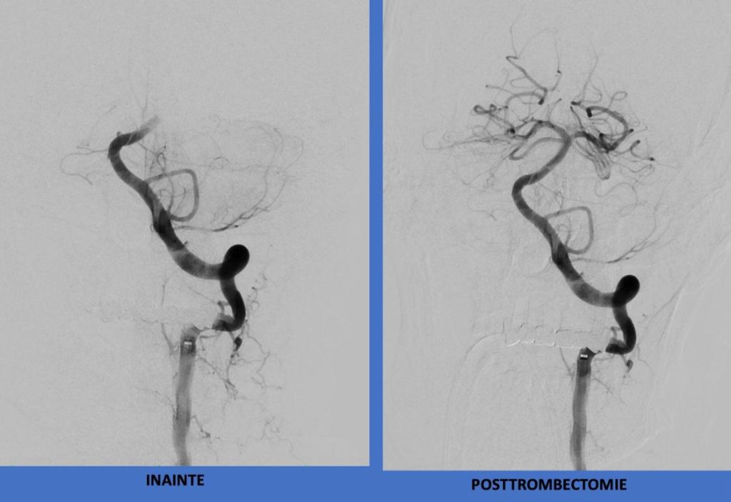 O nouă reușită a echipei de neurologie și radiologie intervențională O nouă reușită a echipei de neurologie și radiologie intervențională